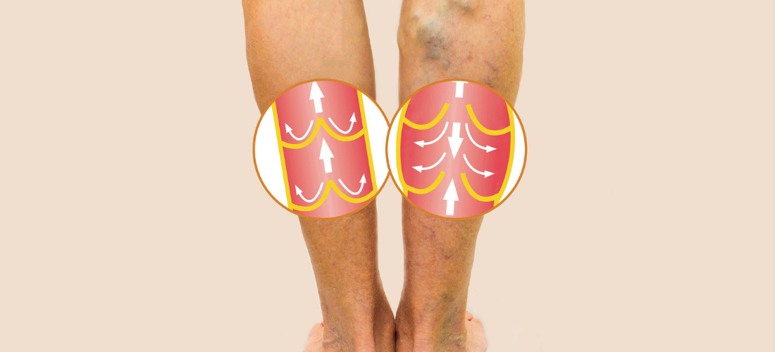 Illustration of vein activity | Doylestown Health